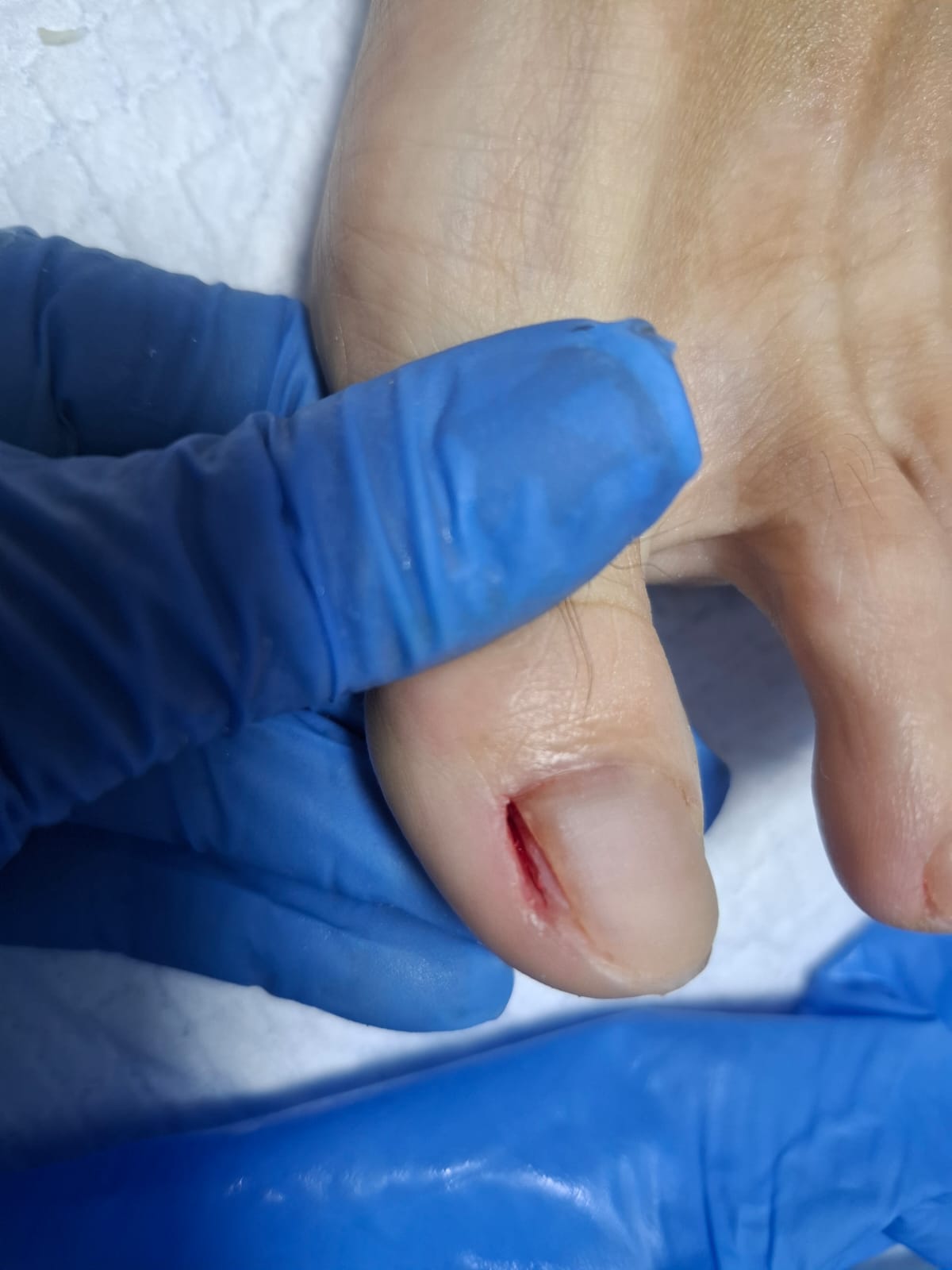 Tratamiento para la Onicocriptosis