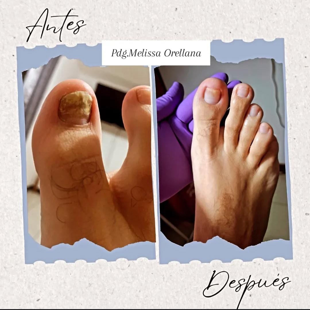 Tratamiento de Onicomicosis (Hongos)