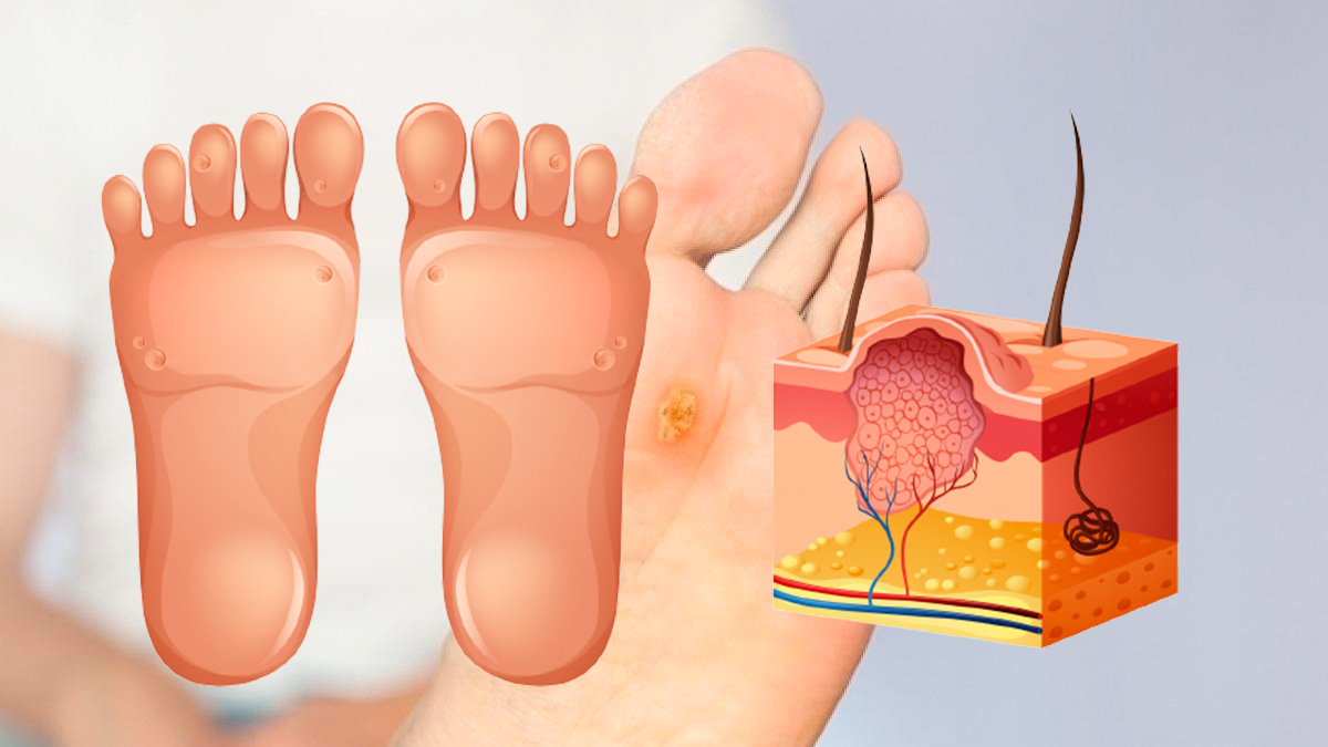 Verruga plantar (VPH)