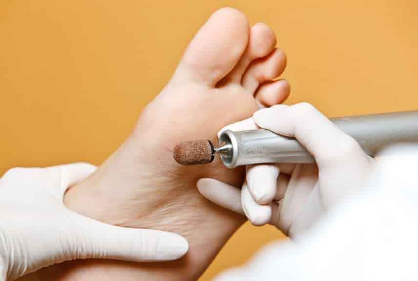 Remoción de Callosidades