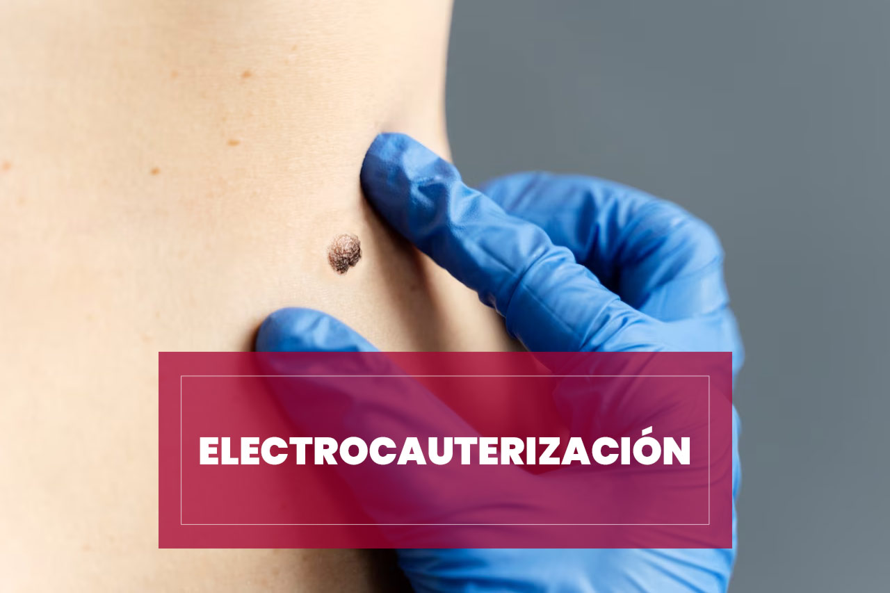 Cauterización