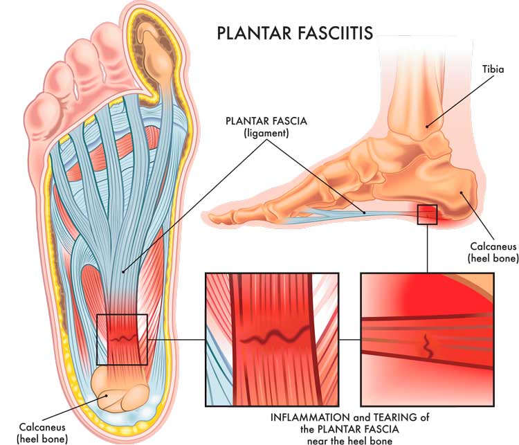Fascitis plantar